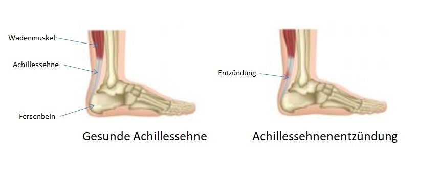 Achillessehnenentzündung Achillessehnenentzündung